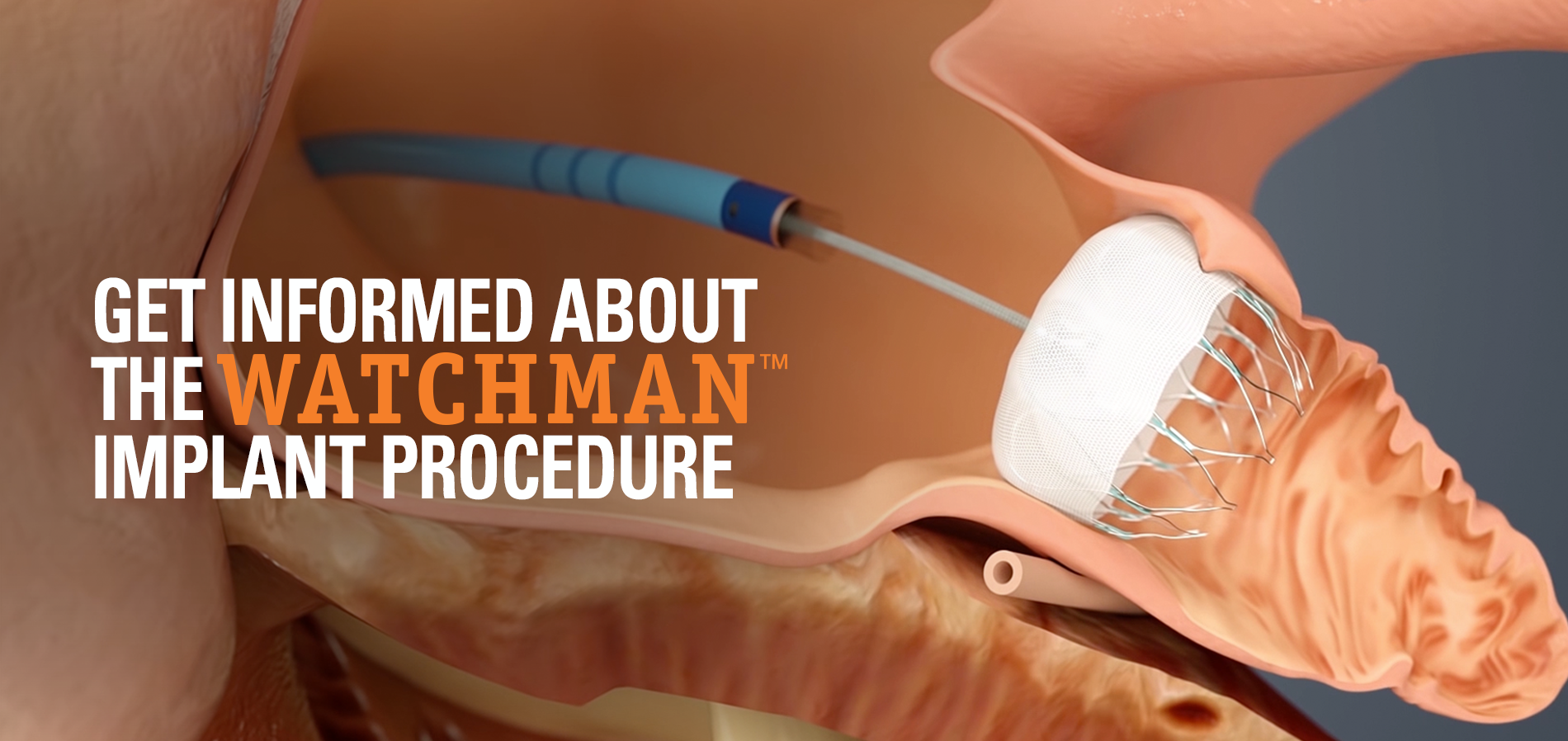 The Implant Procedure WATCHMAN Device